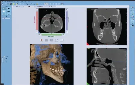 Mobile Cone Beam CT - CBCT imaging 27 newtom-giano-hr-nnt